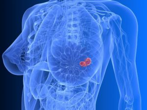 cancro seno mammella