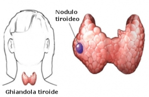 tiroide nodulo