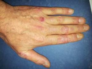 mano con psoriasi artrite unghie