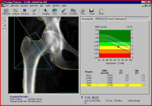 densitometria ossea moc