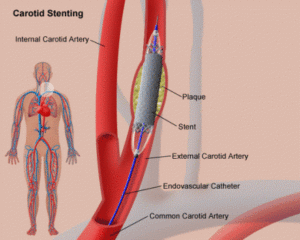 carotidi angioplastica stent